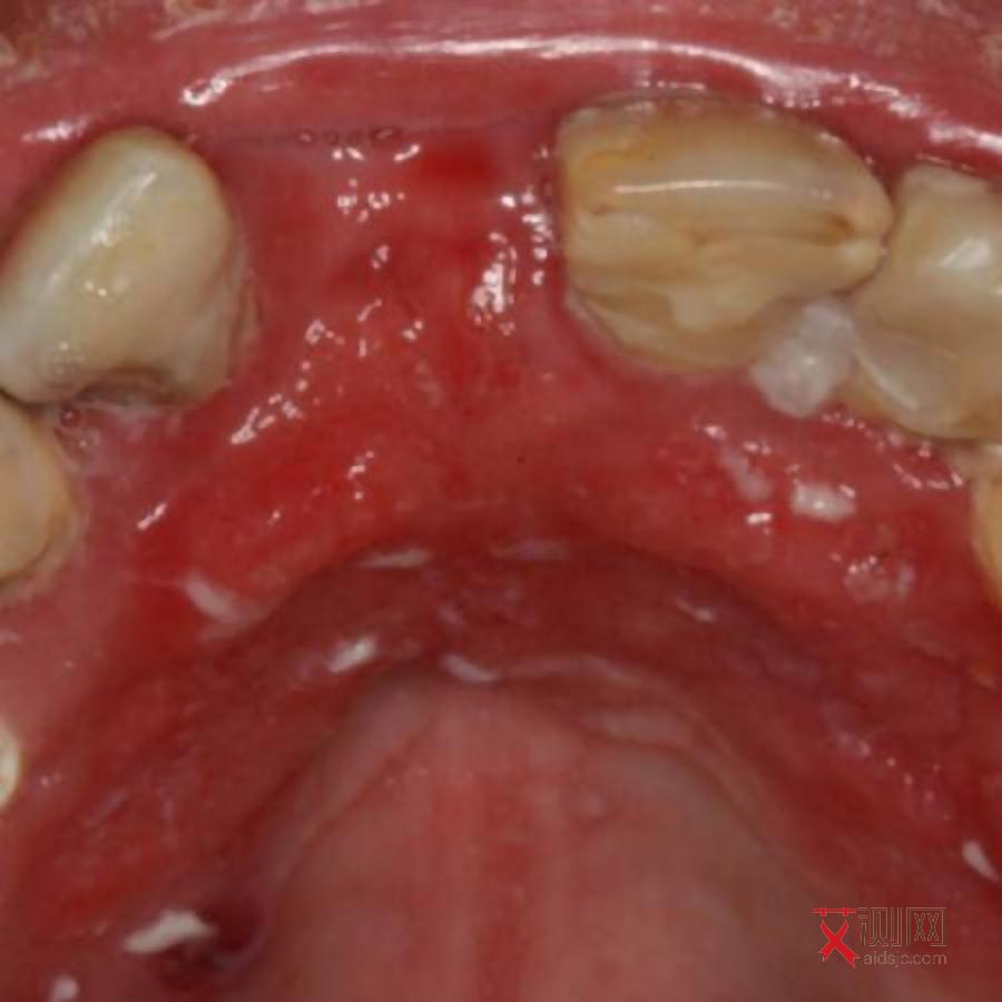 艾滋病初期会有出血点吗会传染吗