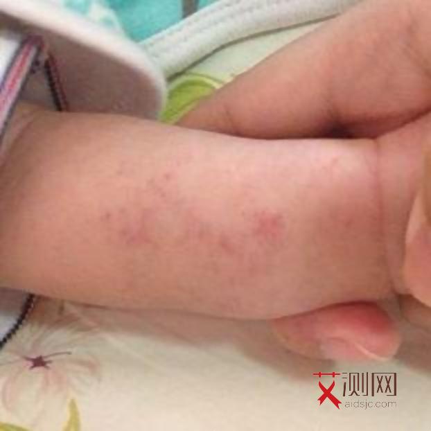 艾滋病毒嘴唇有什么症状图片大全