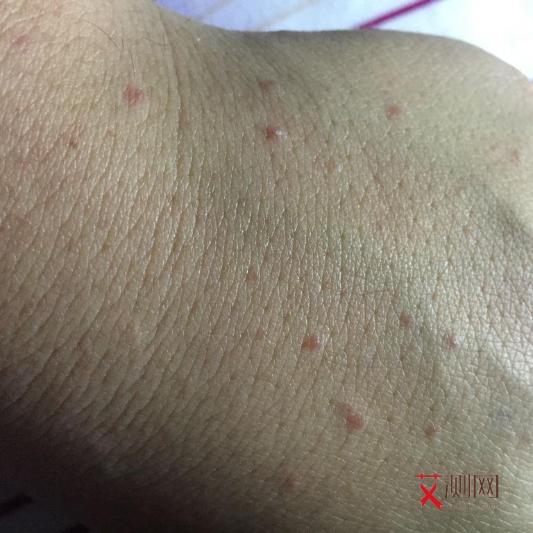 艾滋病各时期症状图片