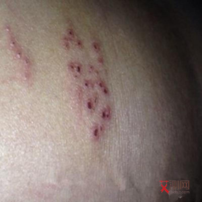 艾滋病女性照片大全