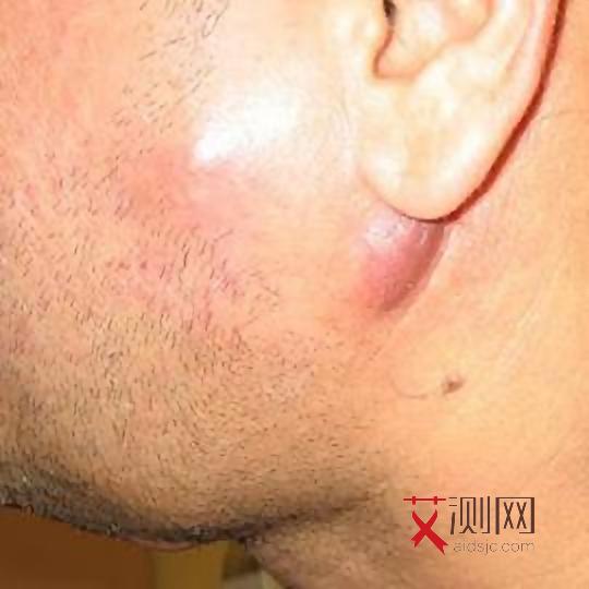 艾滋病出红点会痒吗会传染吗