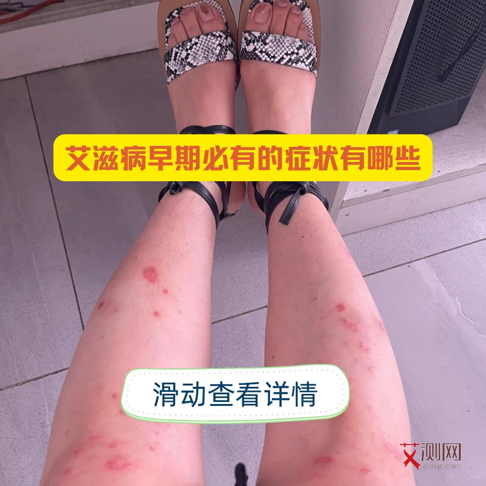 艾滋病皮疹形状图片