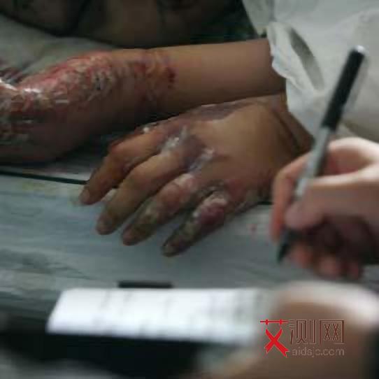 艾滋病起小红点还会伴随其他症状吗图片大全