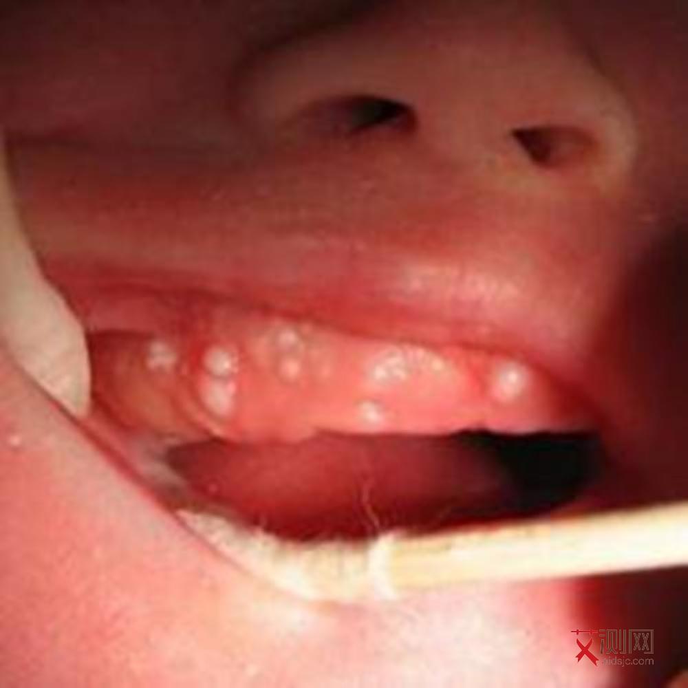 感染了艾滋病应该怎么做