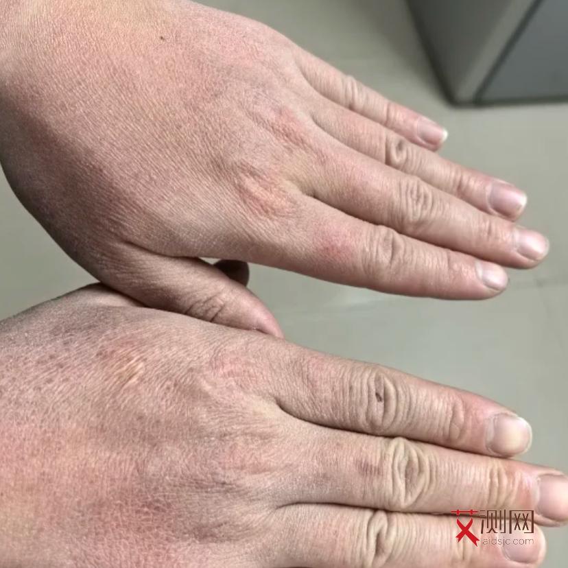 艾滋病患者会痒吗？