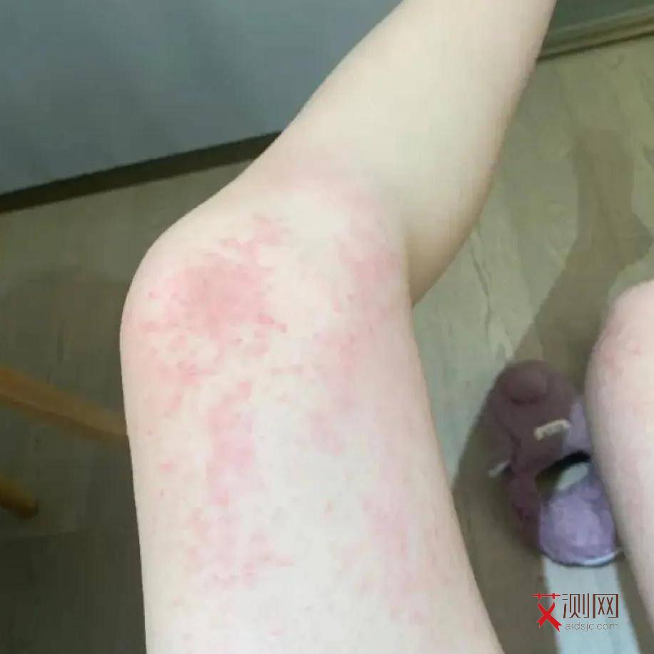 艾滋病的表现特征不包括什么