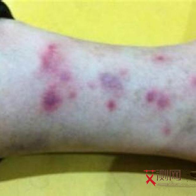 艾滋病病人的图片大全大图最新