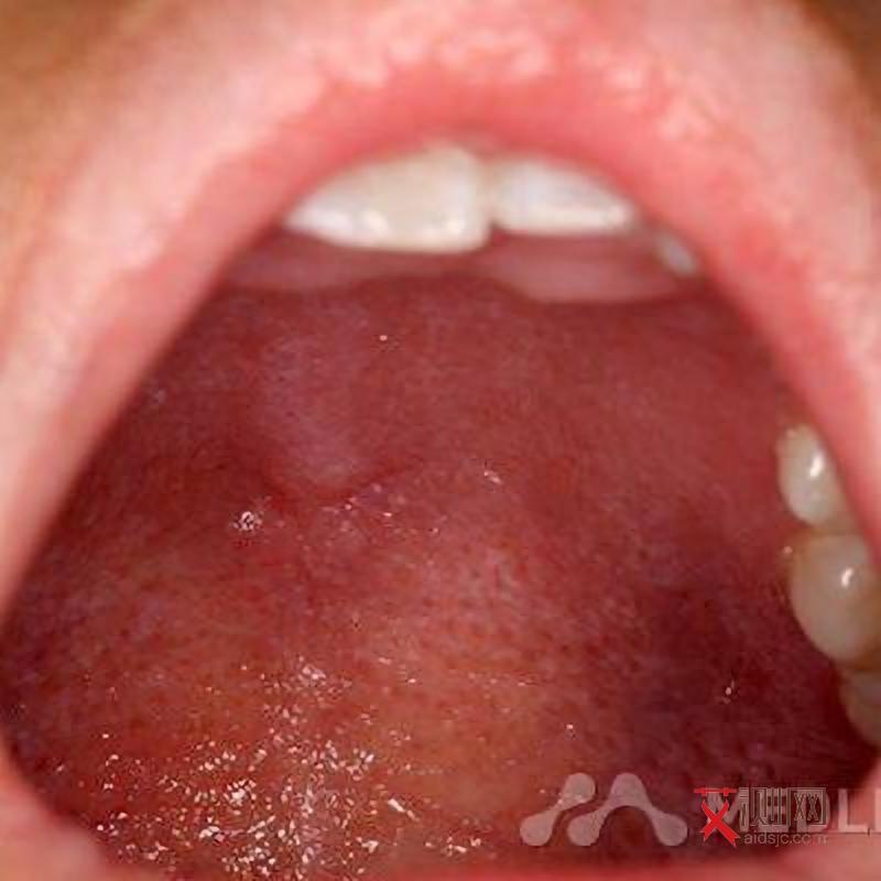 艾滋病皮疹消失后还会不会出