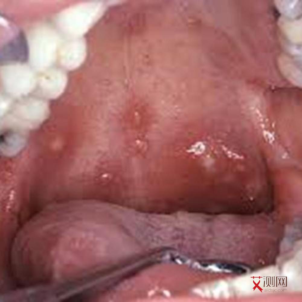 艾滋病下体有什么症状表现男性