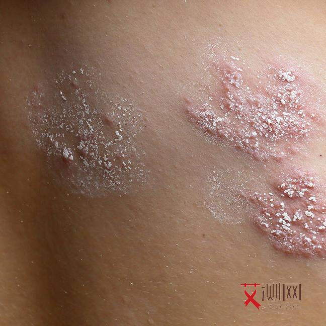 艾滋病的常见症状有哪些表现