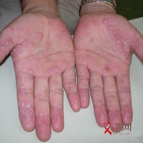 艾滋病初期有感觉吗