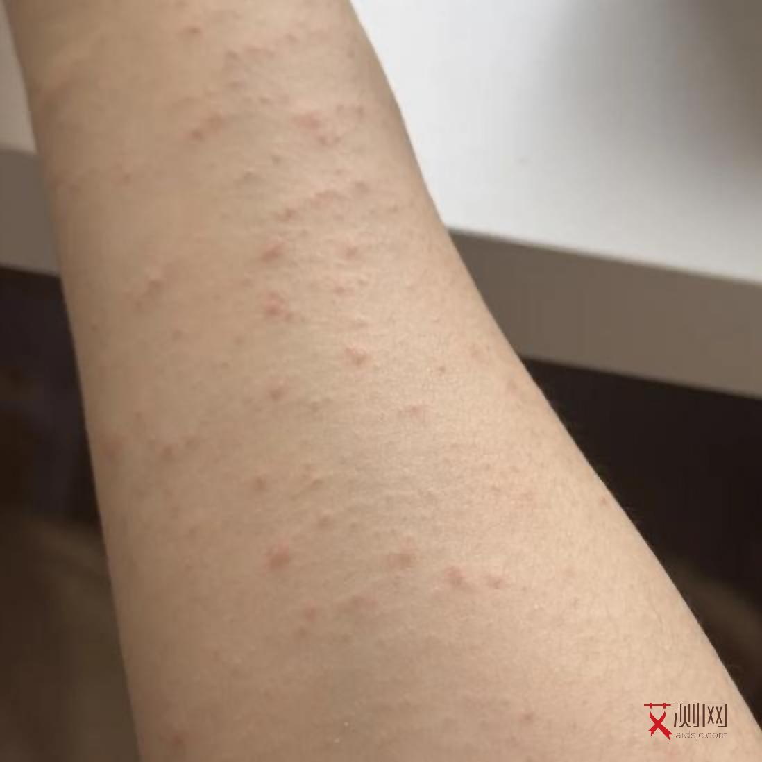 艾滋病各时期症状图片