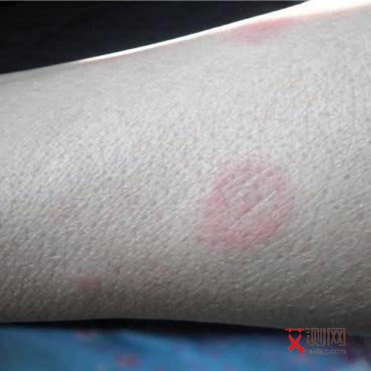 艾滋病患者身上会有异味吗