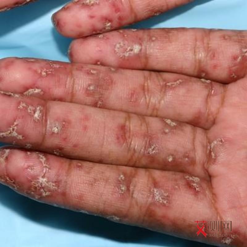 女人艾滋病皮肤有什么症状图片吗