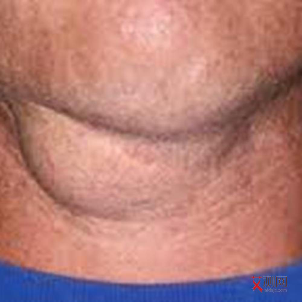 艾滋病会痒吗早期症状女性怎么办图片