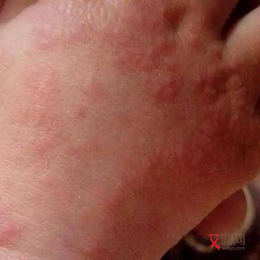 口腔感染艾滋病的例子有哪些症状