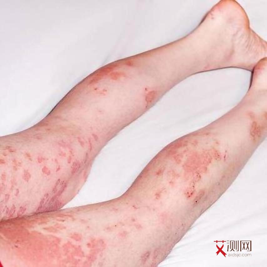 艾滋病图片初期图片大全大图真实