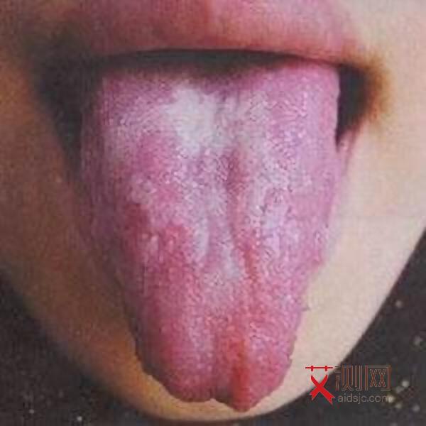 牙龈出血艾滋病毒进去会传染吗图片大全