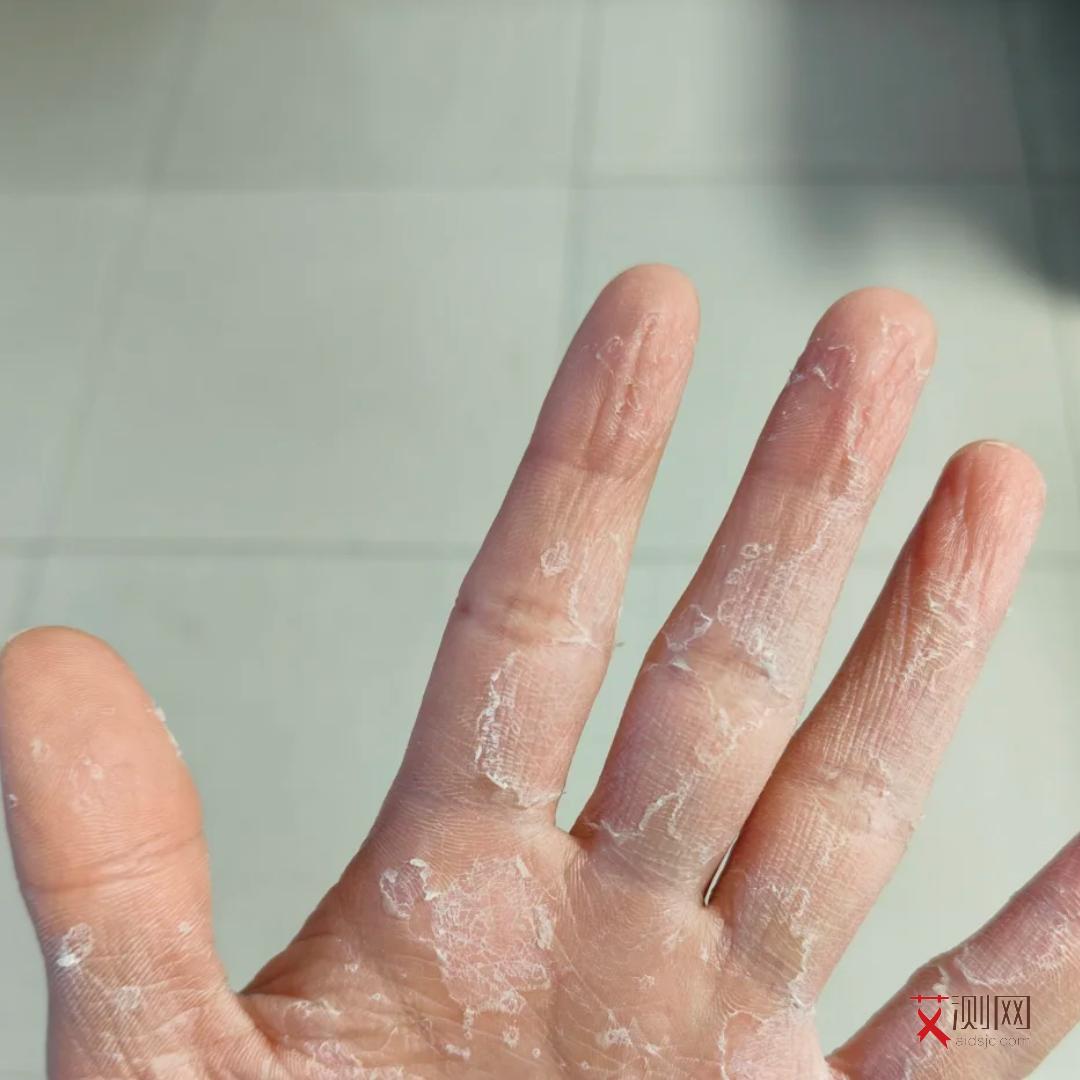 艾滋病最明显最常见的症状为什么