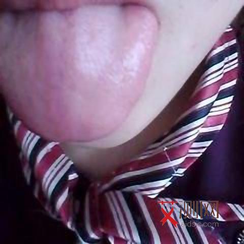 艾滋病症状特点有哪些