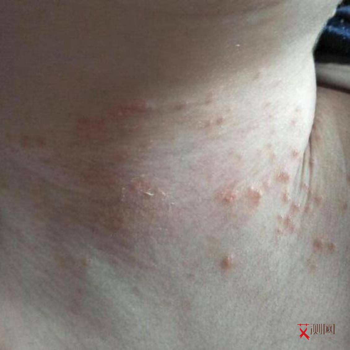 艾滋病初期胳膊上会有很小的的水泡吗