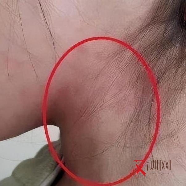 艾滋病的最常见症状是什么样的男性