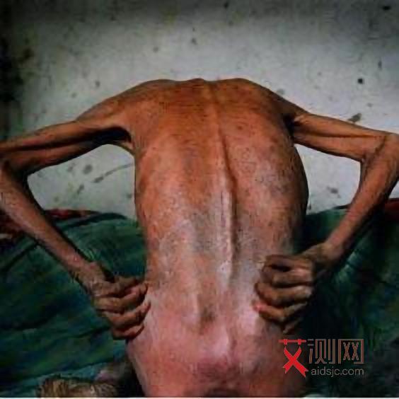 艾滋病早期什么症状最明显表现男性和女性