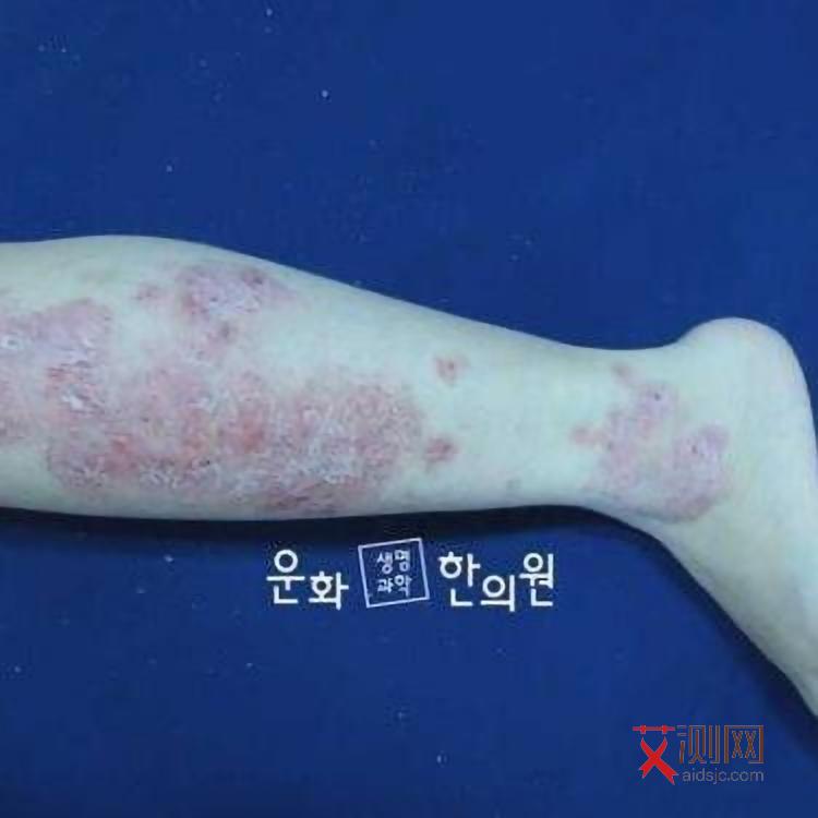 艾滋病出现什么样的皮疹