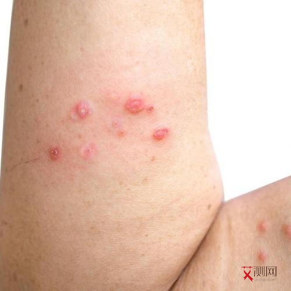 艾滋病的早期口腔表现照片