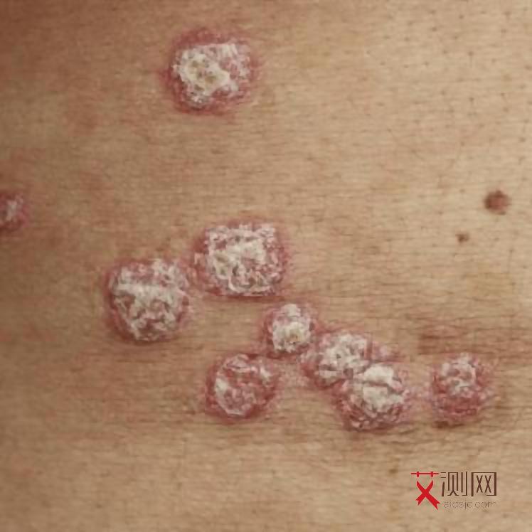 女性艾滋病早期有什么症状表现