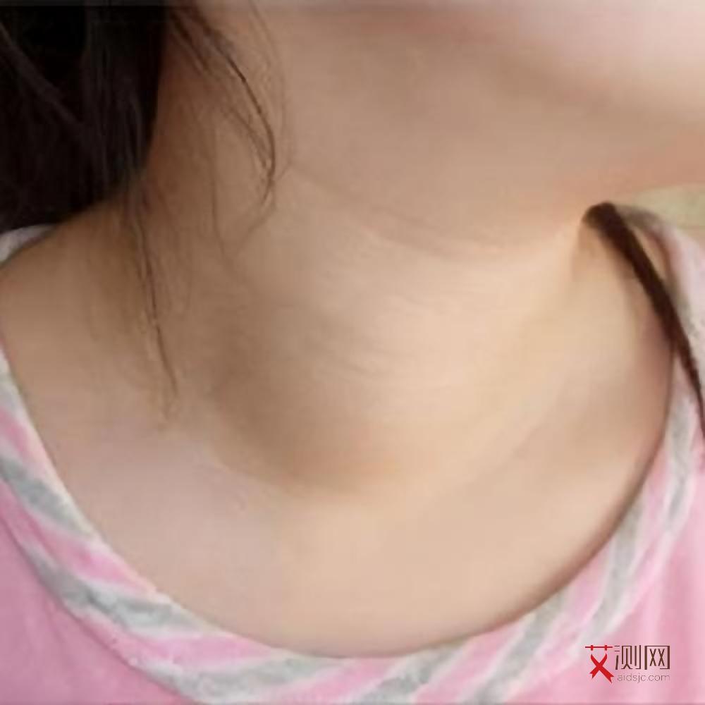 女艾滋病症状有哪些表现