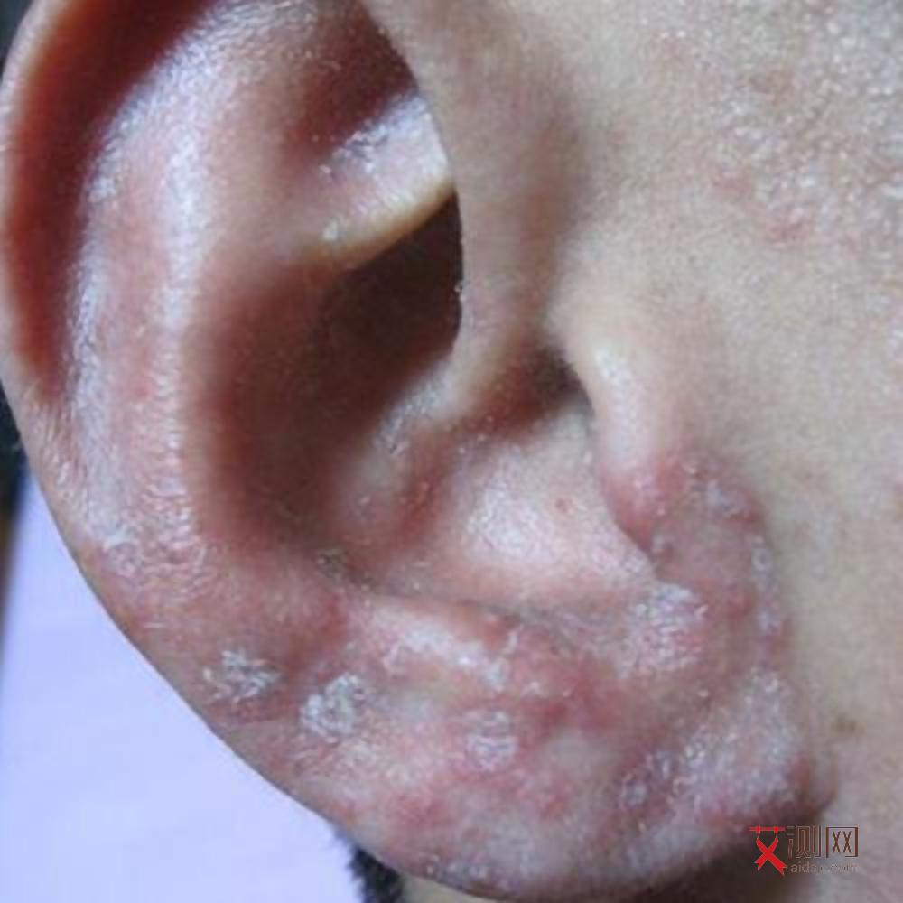 艾滋病多久死掉正常