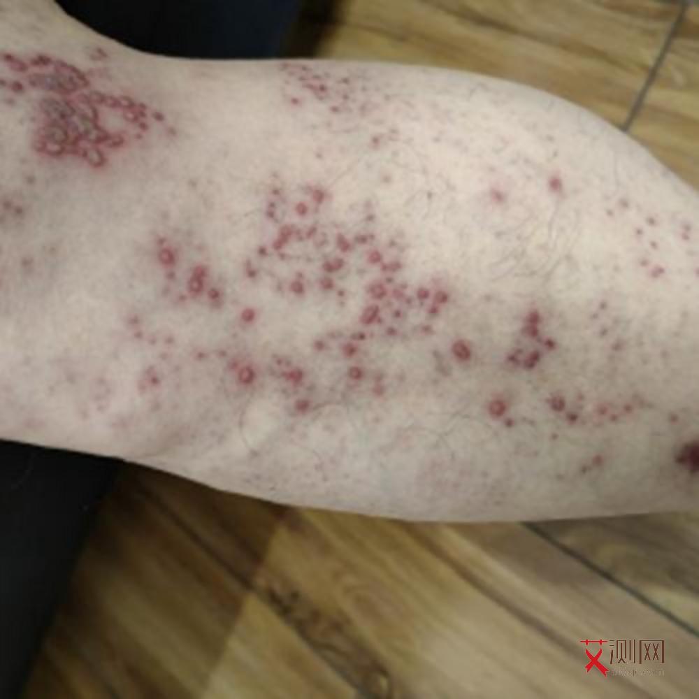 艾滋病初期瘙痒持续多久会好起来呢图片