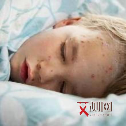 艾滋病的初期小红点会消失吗会传染吗