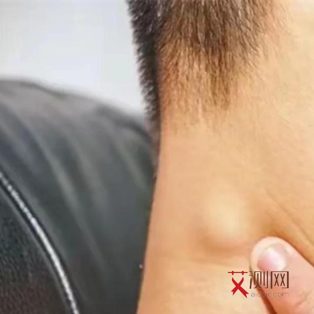 艾滋病的最初症状