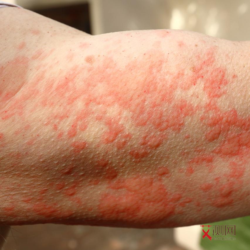 艾滋病的明显特征是什么样的