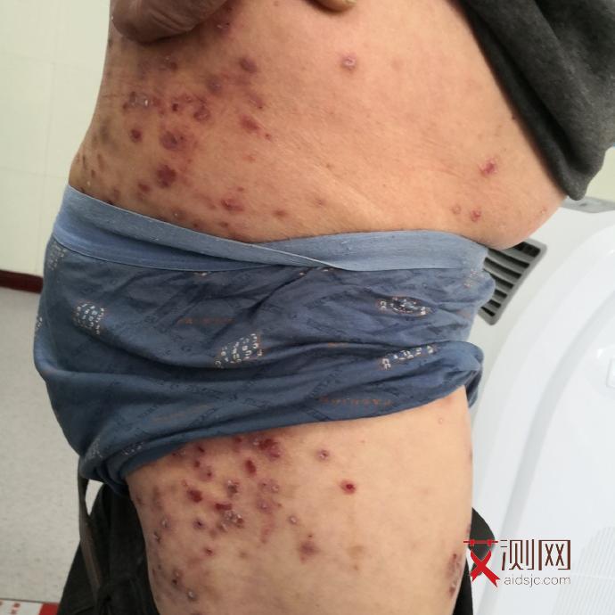 艾滋病初期是什么样子的图片