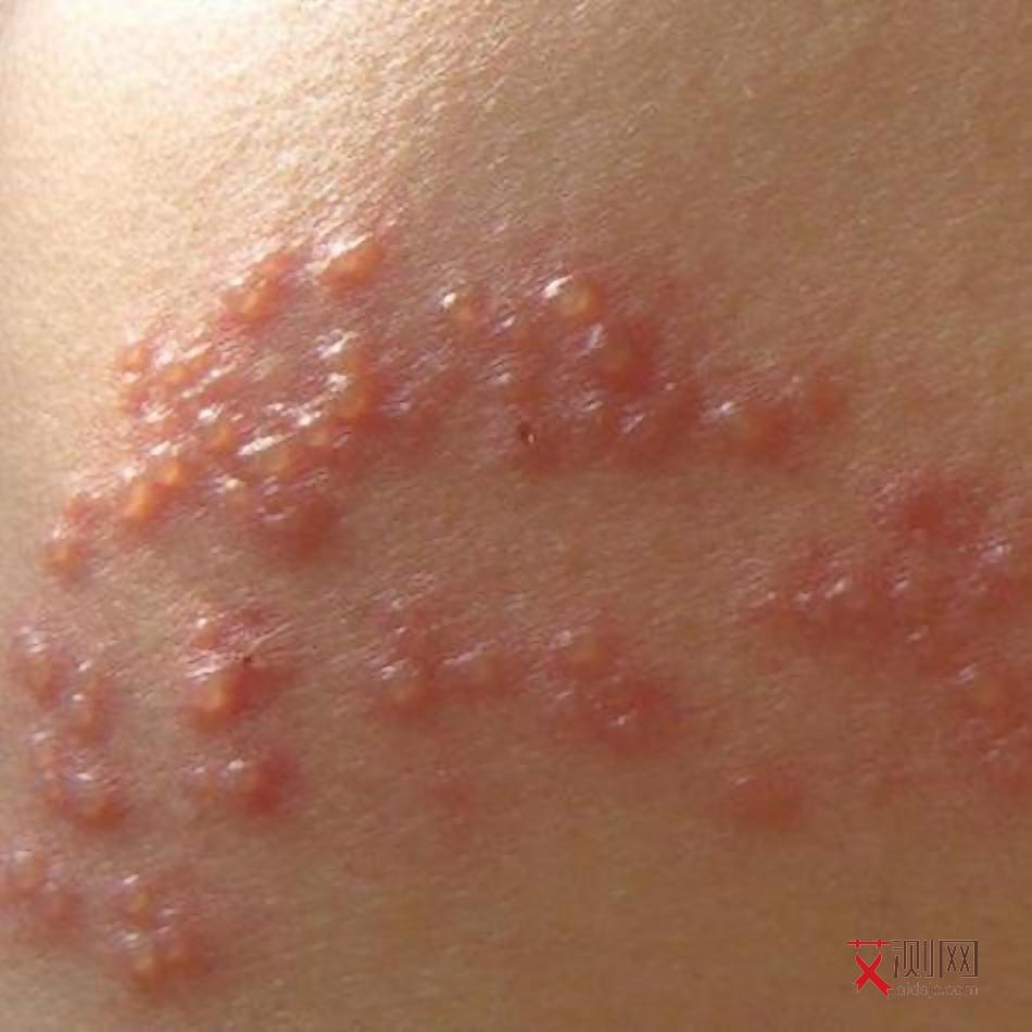 艾滋病人有不发烧的吗