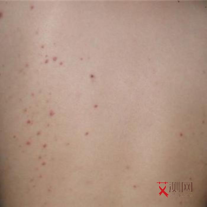 艾滋病患者唾液能传染吗