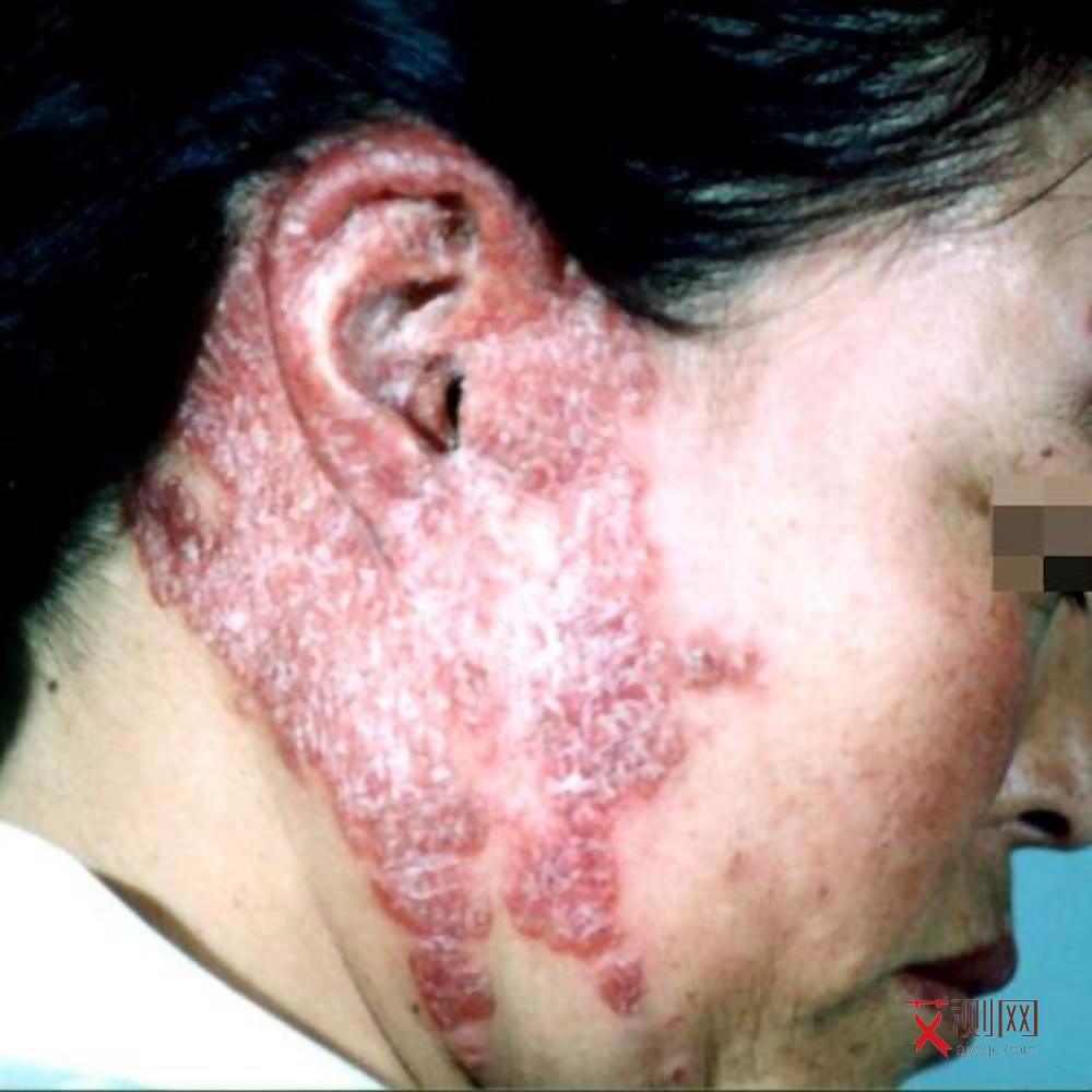 艾滋病出现症状会持续多久呢