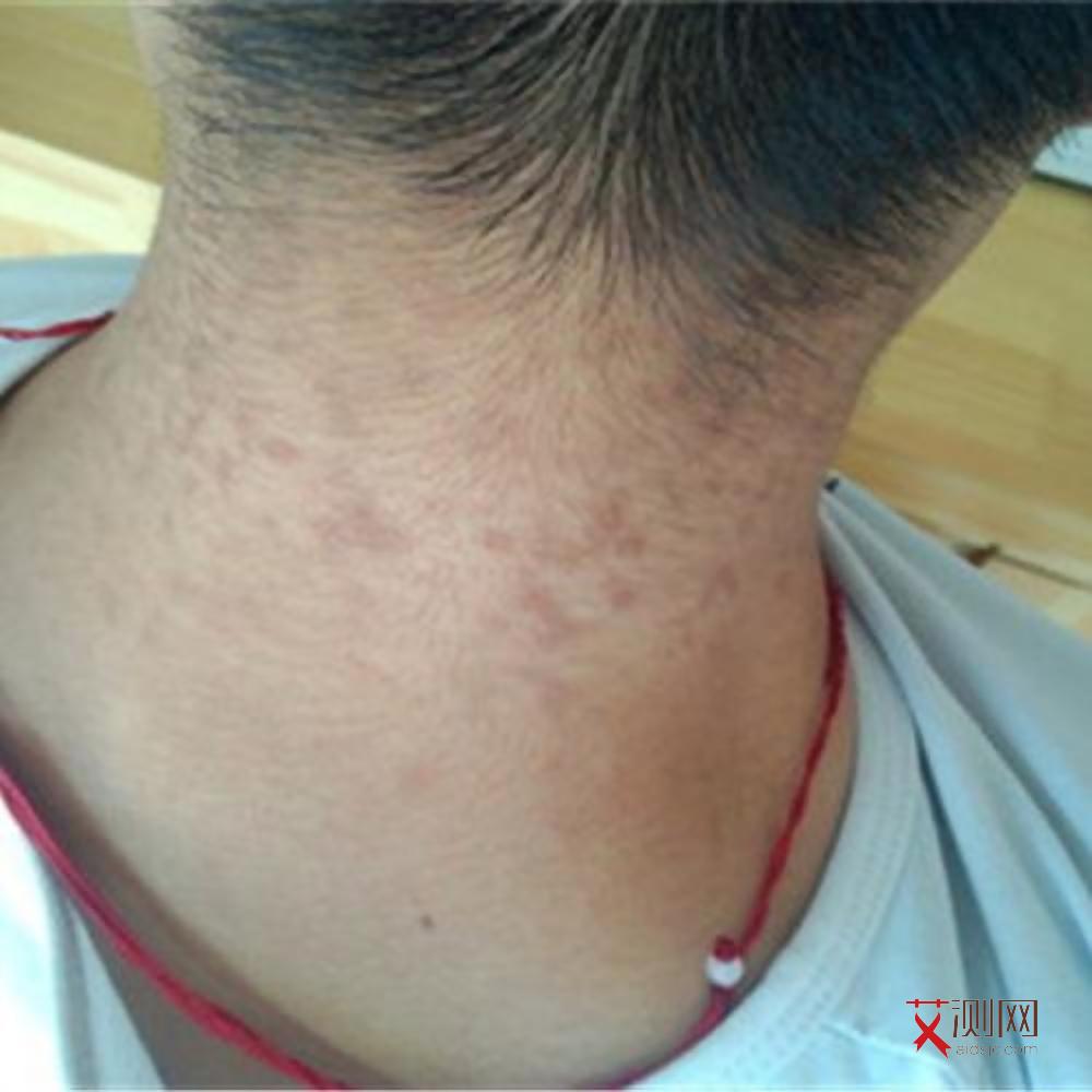 男人感染艾滋病的几率大吗会传染吗