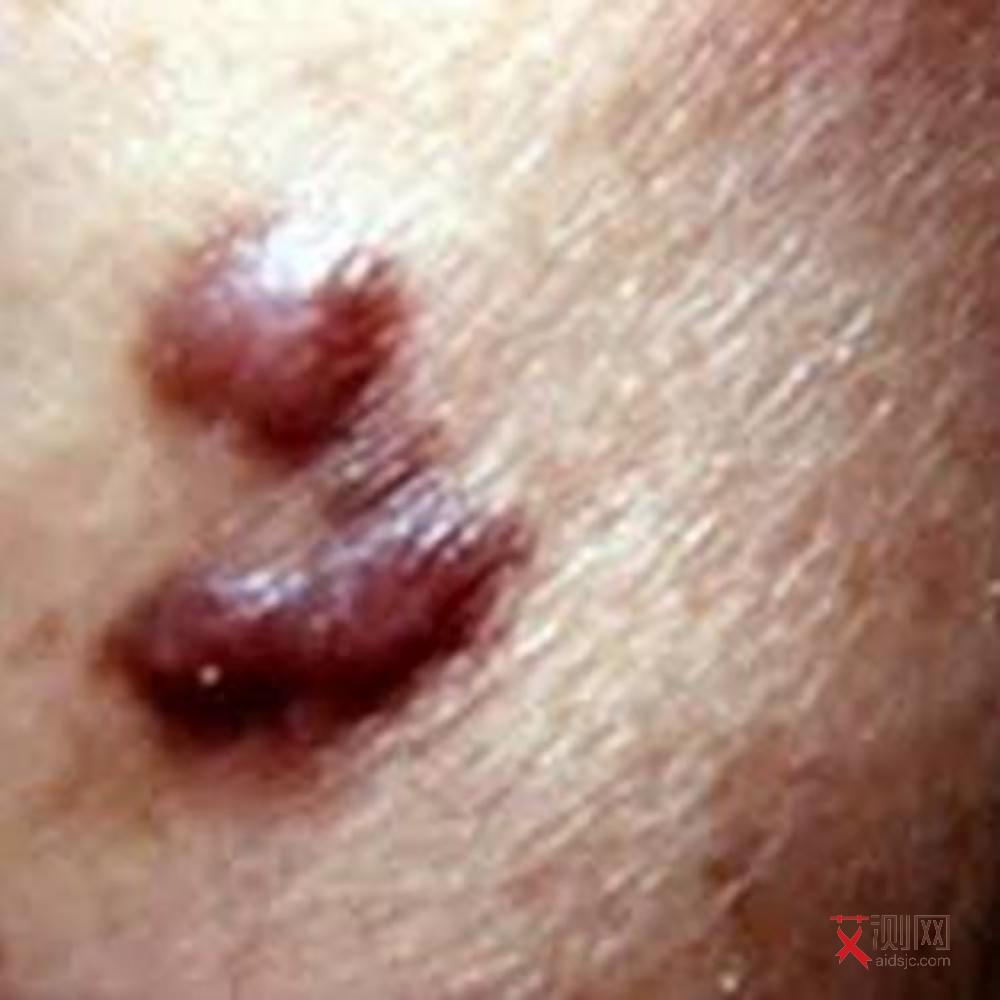 艾滋病初期症状大全图女性表现