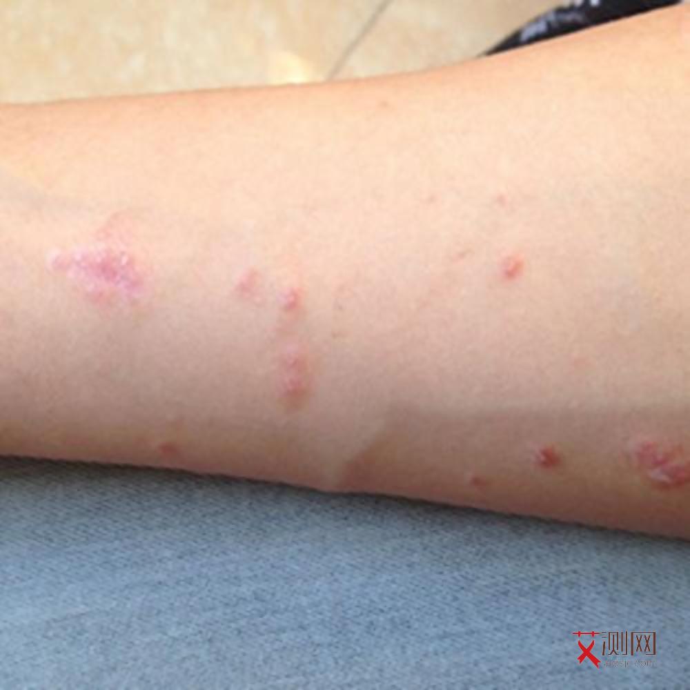 艾滋女性症状有哪些表现图片大全