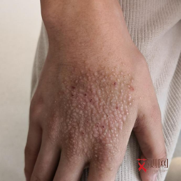 深圳艾滋病人群比例