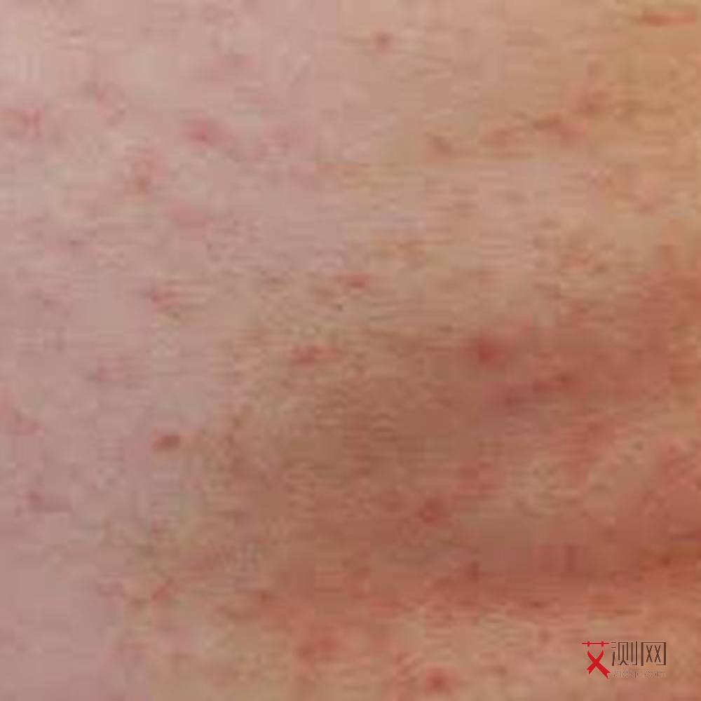 艾滋病人皮肤病图片真实大全