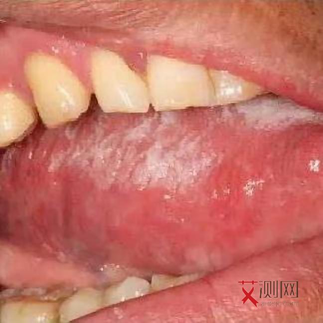 艾滋病初期肯定会有的症状是什么