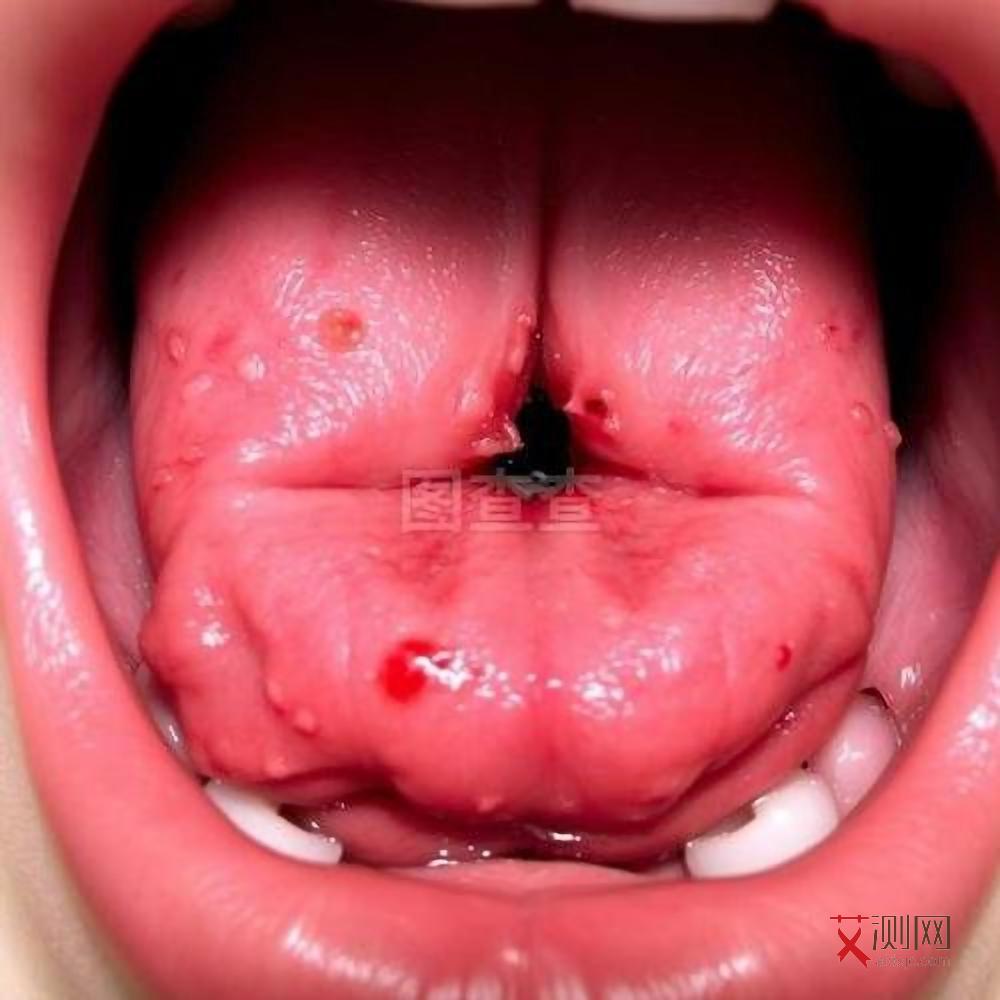 艾滋病大概什么时候有症状呢女性