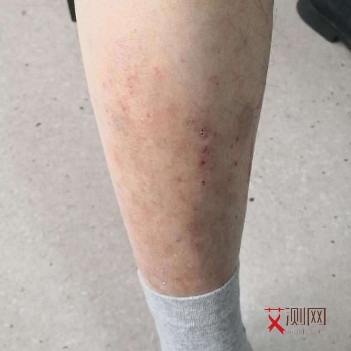 艾滋病多久开始起皮疹症状图片