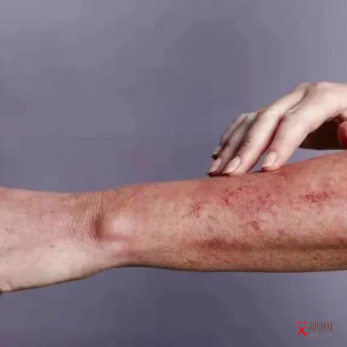 艾滋病的状况图片真实图