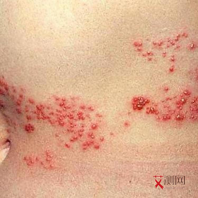 艾滋病早期小红点长在哪里